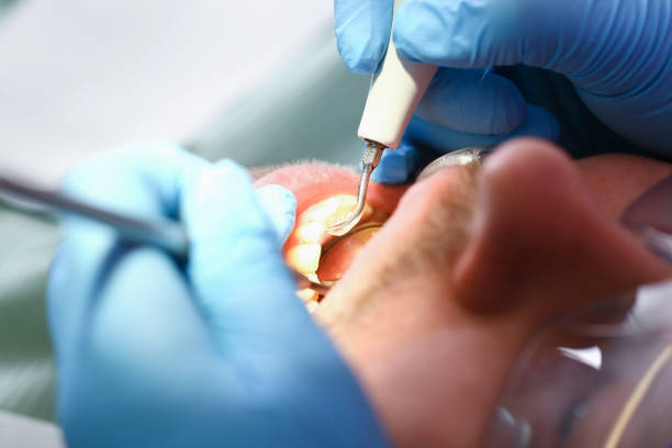 Best Emergency Tooth Extraction in St Helen, MI